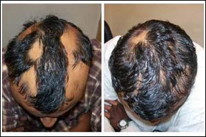 Homeopathy can treat Alopecia Areata : Dr Ujwala Sukale