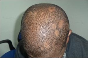 Some cases in which stress gave Alopecia Areata and others Alopecia Aareata gave anxiety and stress.